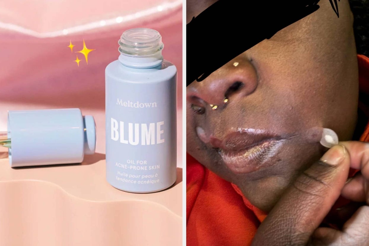 27 Products To Help You Nip Face *And* Body Acne In The Bud